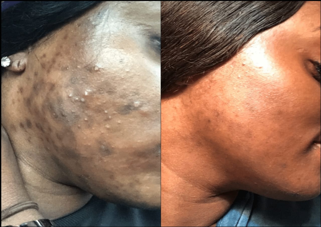 GEL ACNE CLEAR